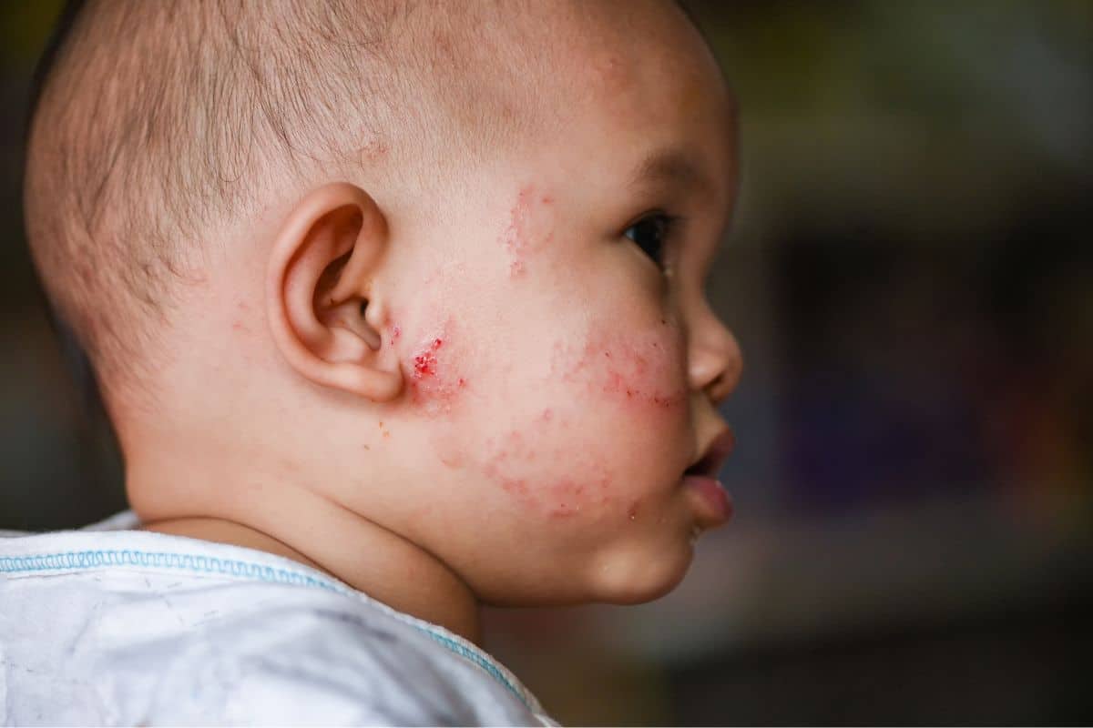 side profile of a baby with eczema on their cheeck