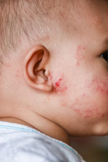side profile of a baby with eczema on their cheek