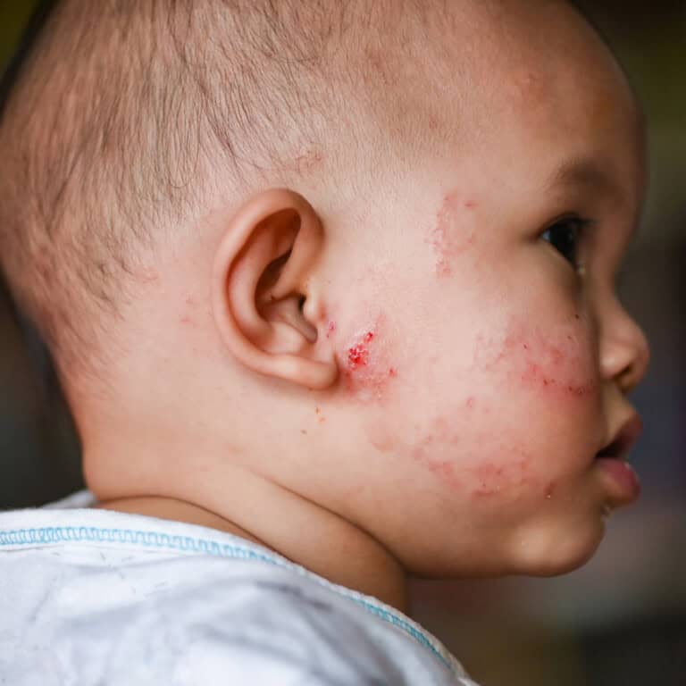 side profile of a baby with eczema on their cheek